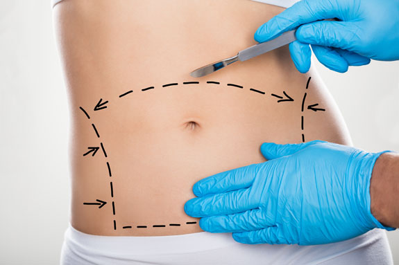 Abdominoplastik Bayreuth